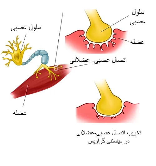 بیماری میاستنی گراویس از موارد احتیاطی مصرف داروی اریترومایسین